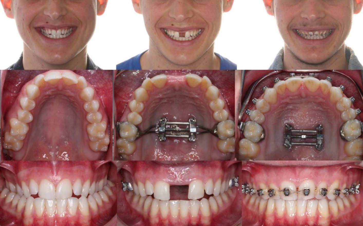 MSE Treatment - Mars Orthodontics